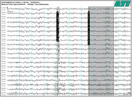 Arriba Imagen 7: Fragmento del Electro-encefalograma de base. Sujeto quieto, con ojos cerrados e hiperventilando. Valores normales.